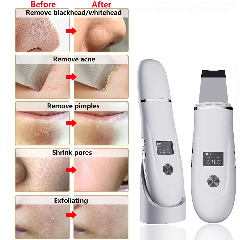 Nettoyeur de Peau Ultrasonique 3-en-1 – Points Noirs, Nettoyage Profond & Massage Liftant