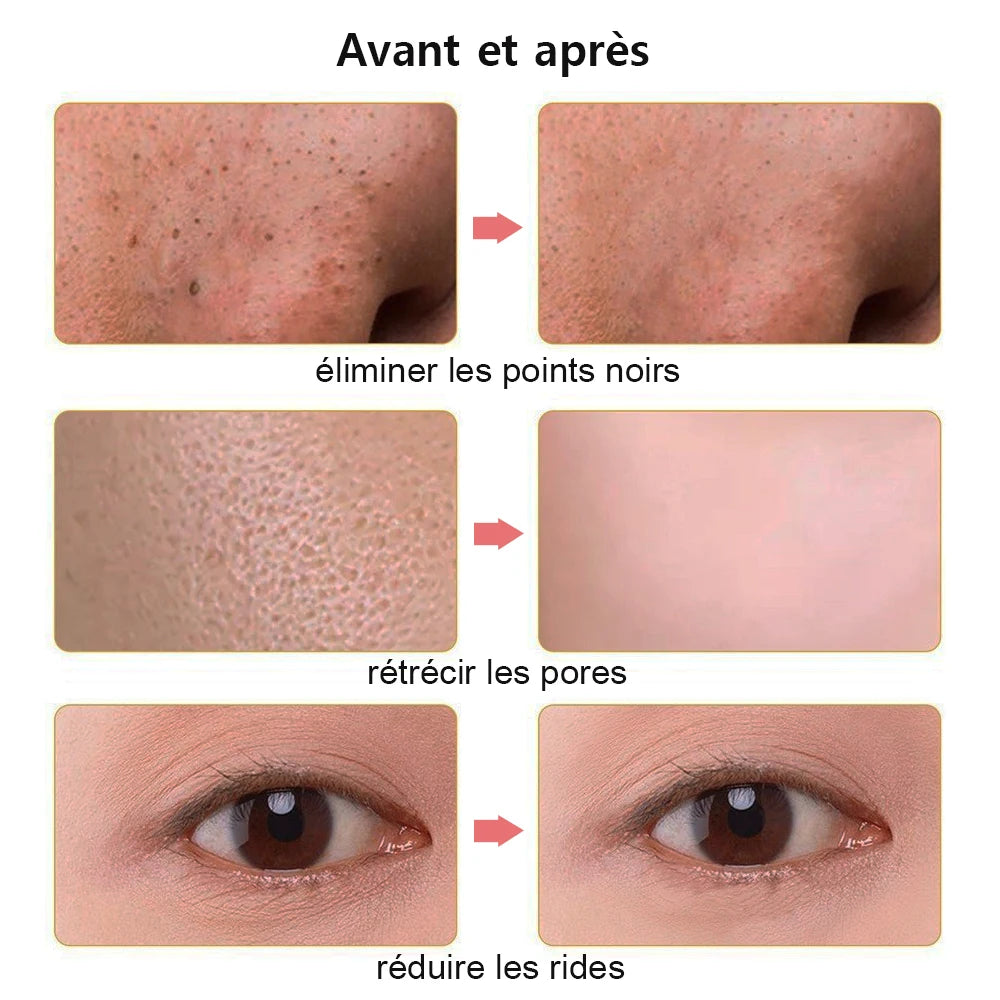 Nettoyeur de Peau Ultrasonique 3-en-1 – Points Noirs, Nettoyage Profond & Massage Liftant